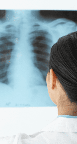 A person in a white lab coat is examining an X-ray film of a human chest.